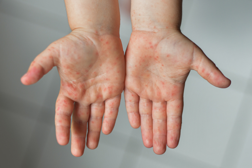 enterovirus-legs-hands-mouth-rash-body-child-cocksackie-virus.jpg