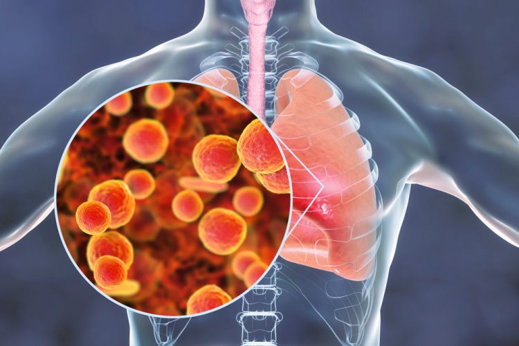 Микоплазменная пневмония - причины появления, симптомы заболевания, диагностика и способы лечения
